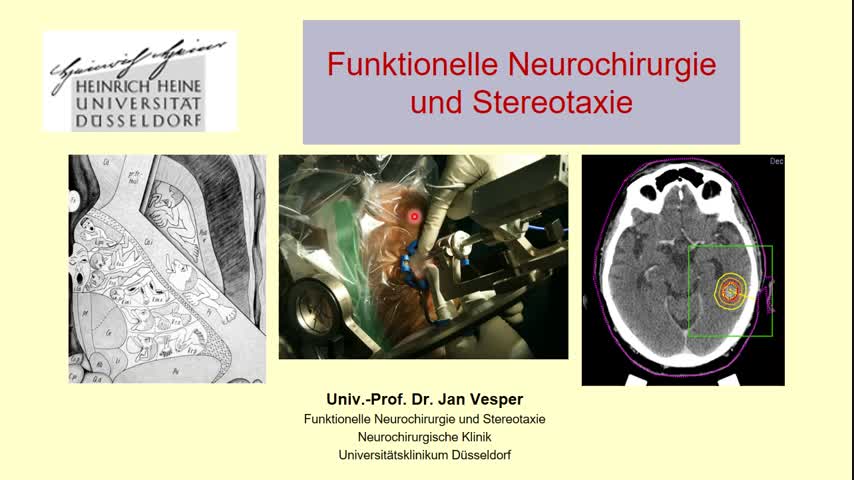 Kopf-Nervensystem-Neurochirurgie-Funktionelle Neurochirurgie Vesper